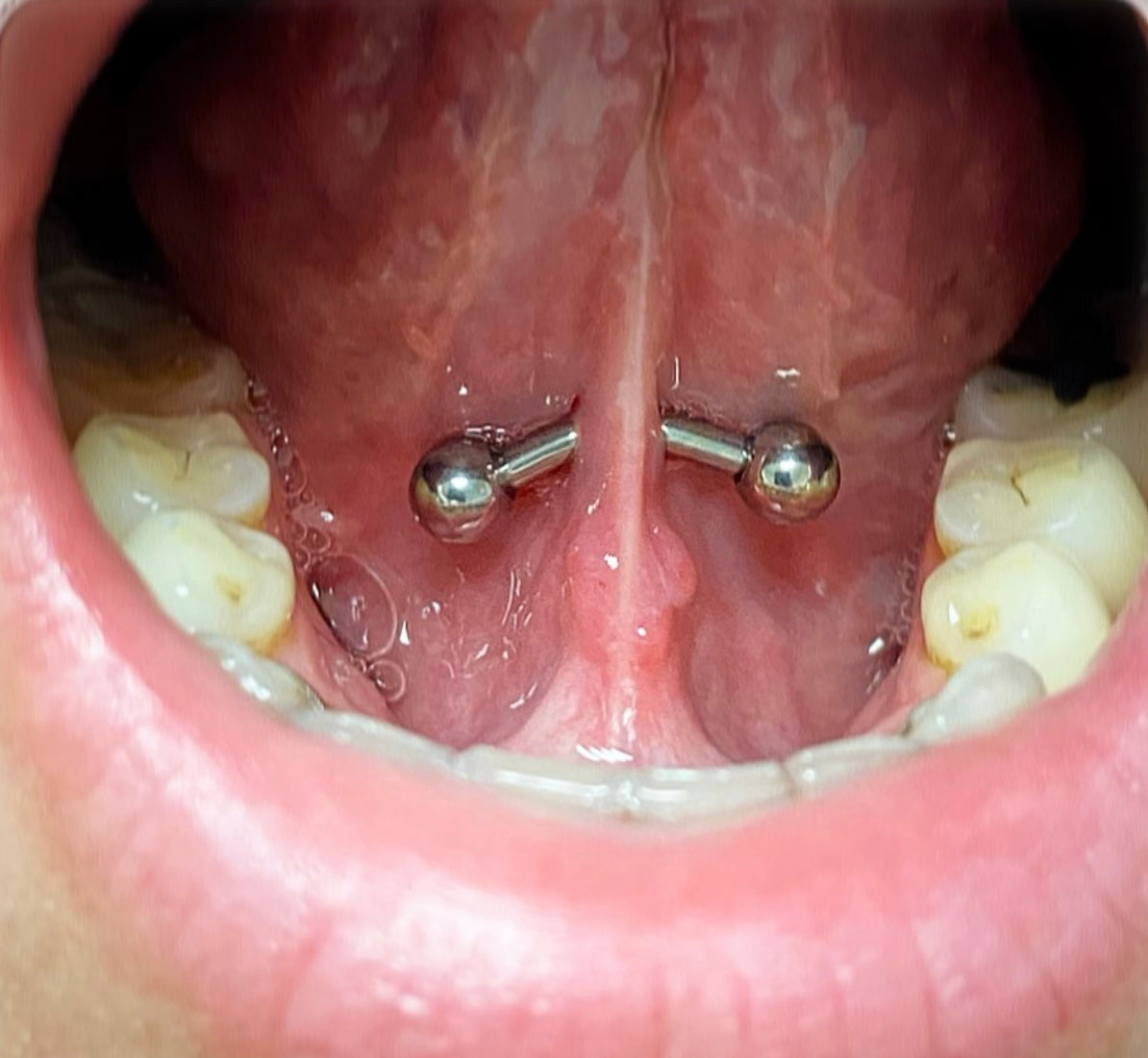Lingual Frenulum