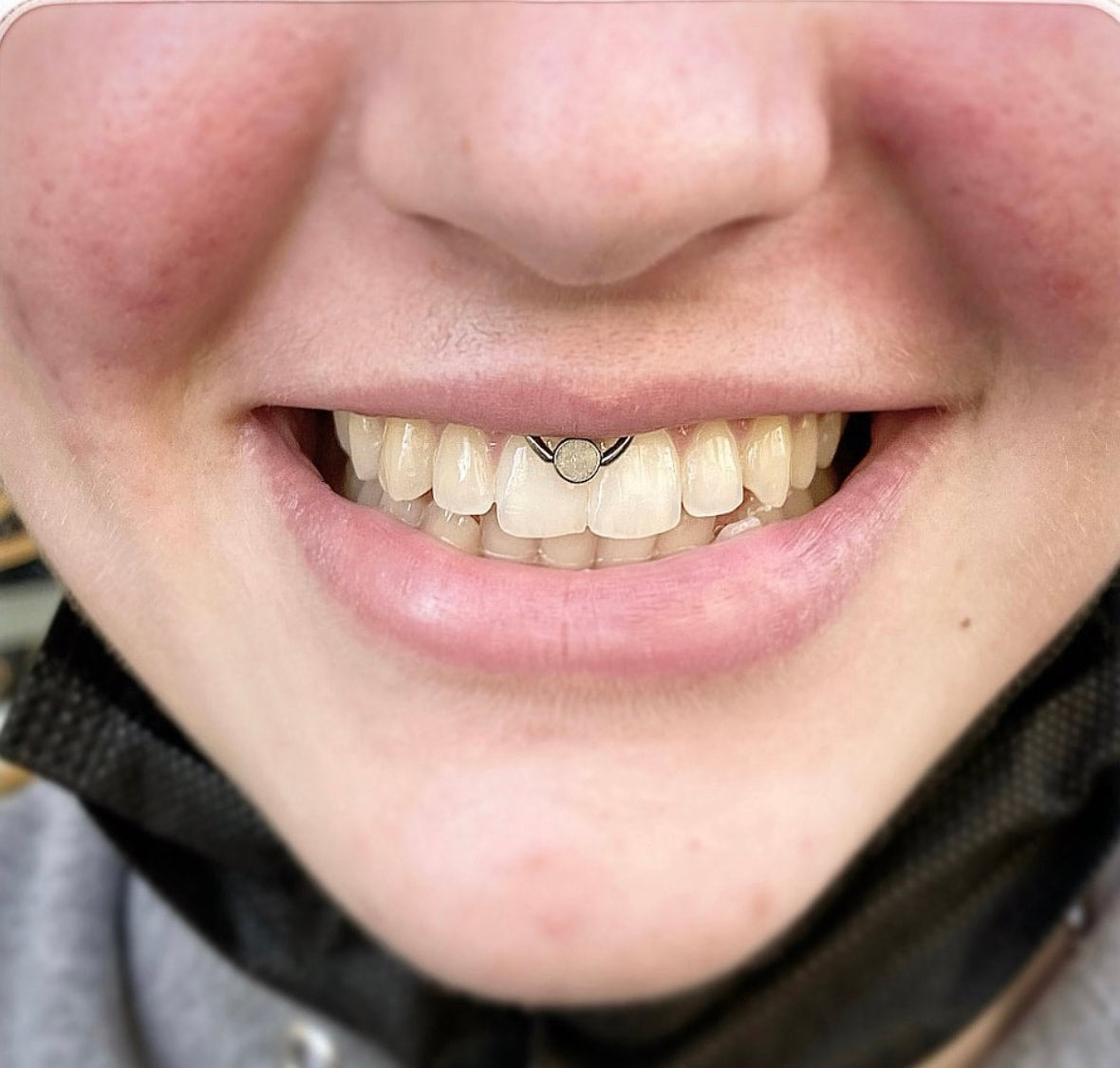 Smiley Piercing